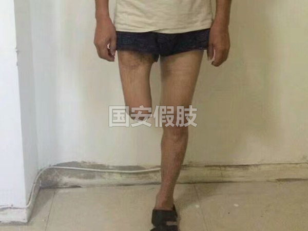 長(zhǎng)沙國(guó)安假肢康復(fù)用品有限公司,長(zhǎng)沙假肢用品,國(guó)安假肢康復(fù)用品,假肢矯形器,康復(fù)器材,假肢配件,矯形器支具